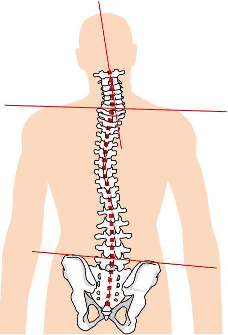 坐骨神経痛は骨盤の歪みが原因で起こります。