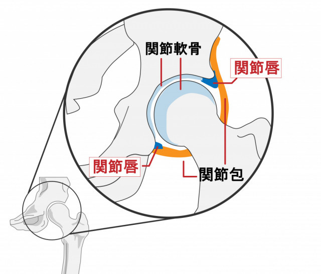 変形性股関節症の原因とは?